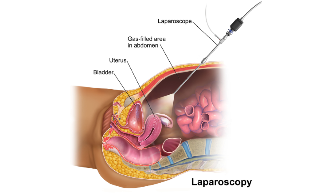 Лапароскопічна хірургія